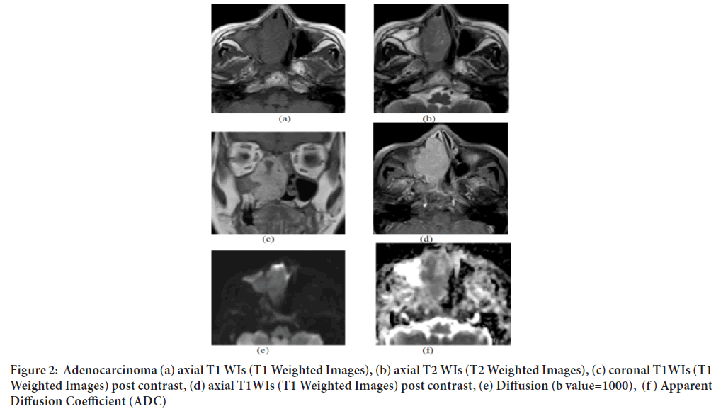 Adenocarcinoma