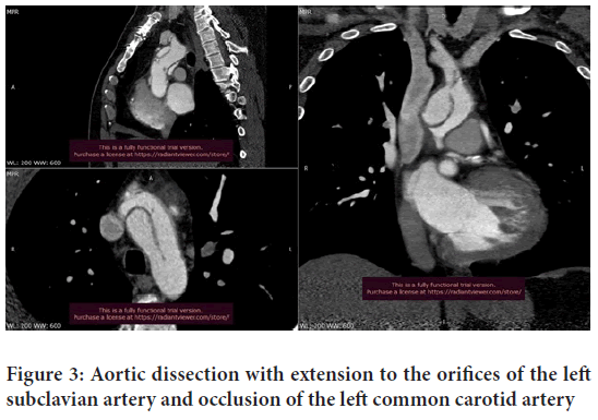 Aortic