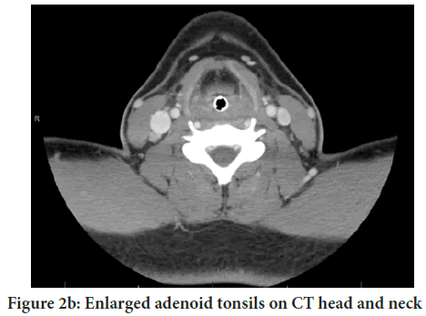 adenoid