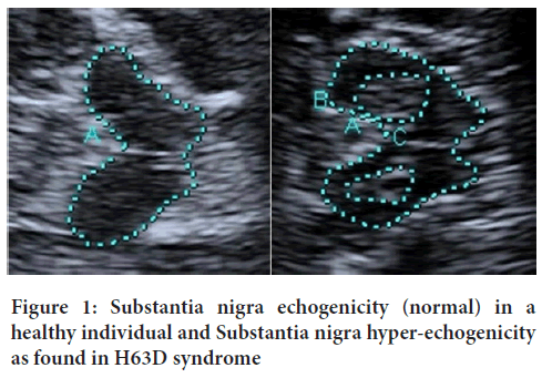 echogenicity