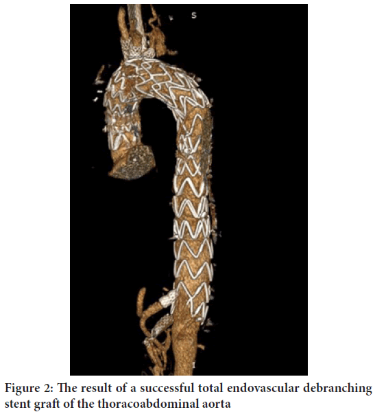 endovascular