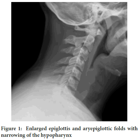 epiglottis