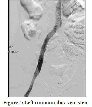 iliac