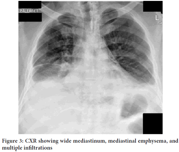 mediastinum