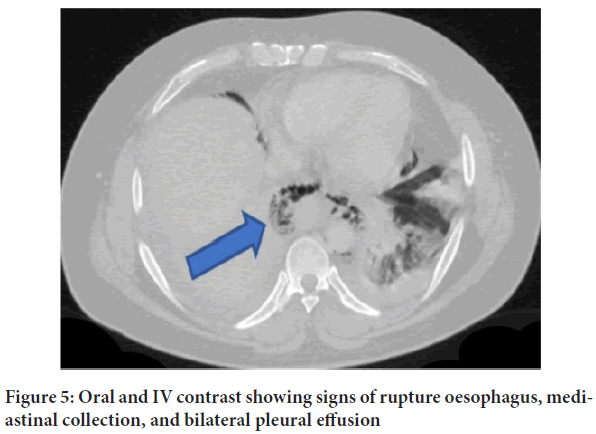 oesophagus