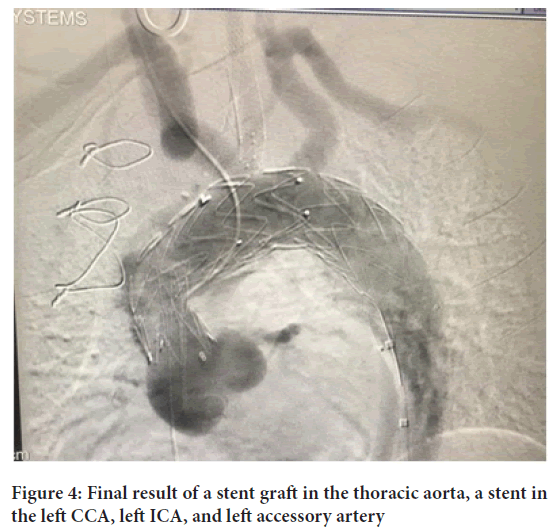 stent