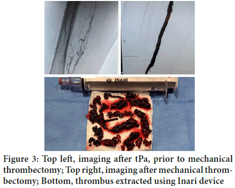 thrombectomy