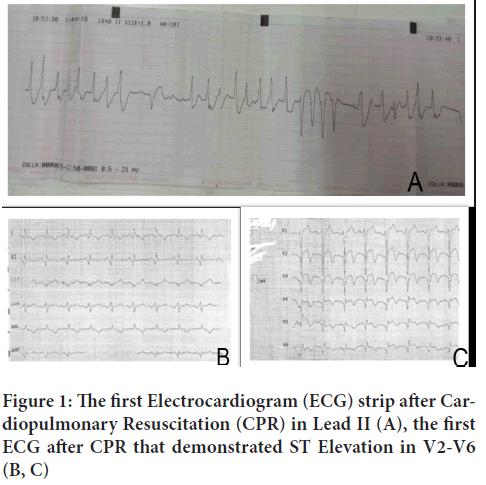 Electrocardiogram