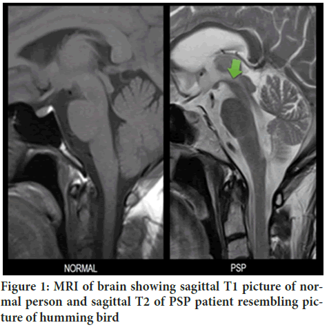 MRI