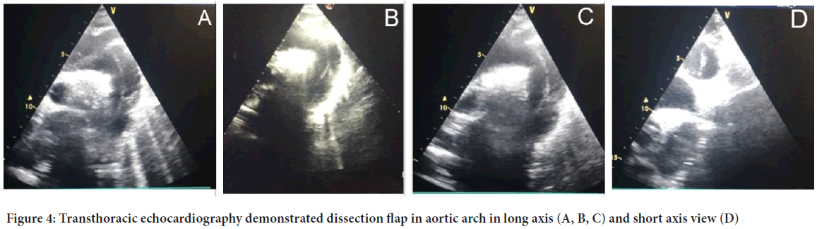 Transthoracic