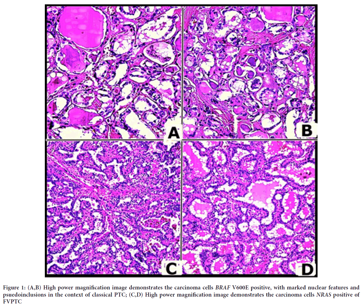 carcinoma