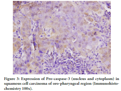 carcinoma