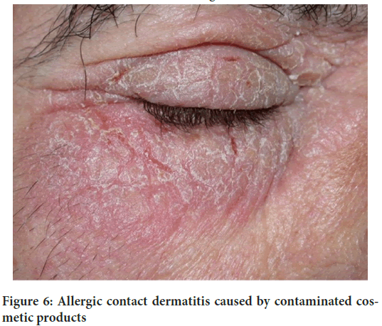 dermatitis