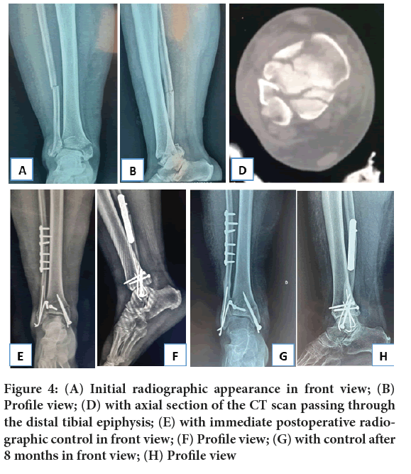 sys-rev-tibial